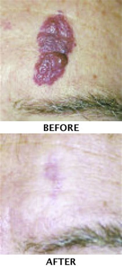 Vascular Lesions | Sukal Skin Institute | Boca Raton, FL