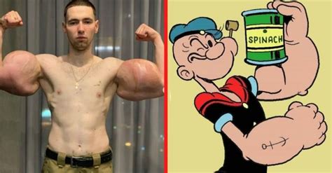 This Real-Life Popeye Has 3 Lbs Of Dead Muscle Removed From Biceps