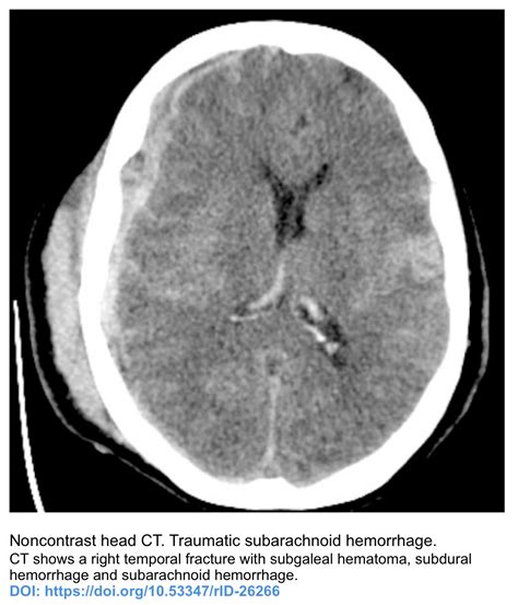 Traumatic Subarachnoid Hemorrhage