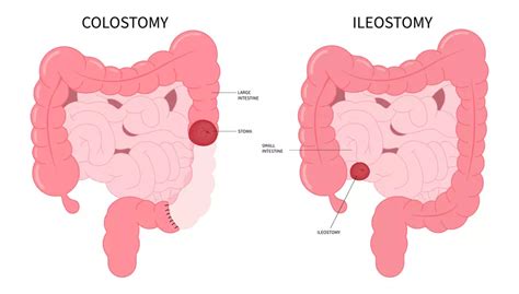 Colostomy Archivos - SIIL Ostomy