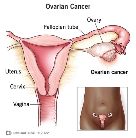 How Big Is An Ovary