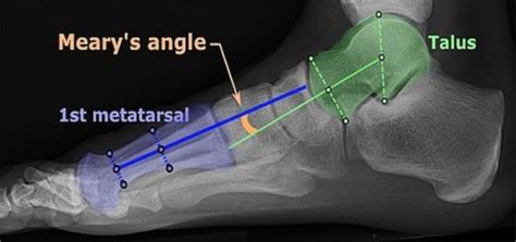 Metatarsalgia - Sandals Digest