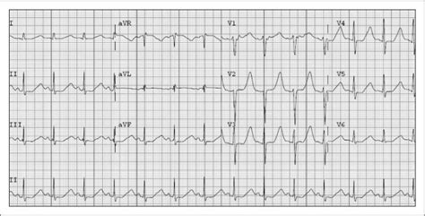 ECG Diagnosis: Hypokalemia | The Permanente Journal