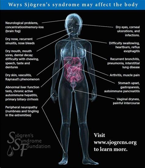 Sjogren's Syndrome | Fibromyalgia & other Autoimmune Diseases | Pinterest