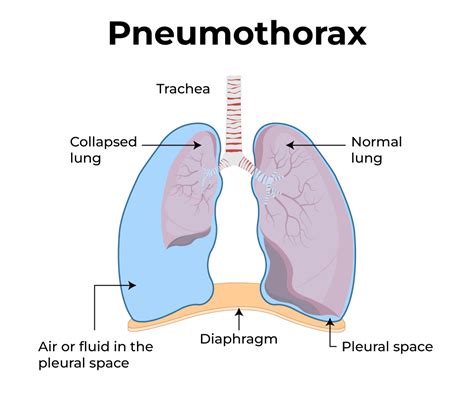 Differentiates A Tension Pneumothorax From A Simple Pneumothorax