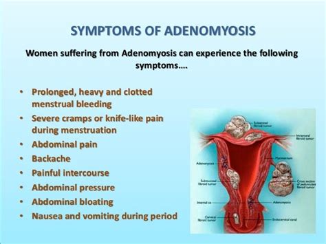 Treatment Of Adenomyosis PPT