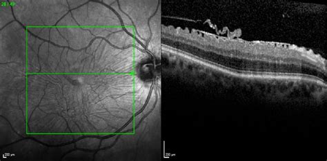 Epiretinal Membrane Surgery Recovery