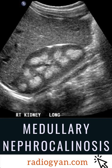 Medullary Nephrocalcinosis | Radiology Case | RadioGyan.com | Radiology ...