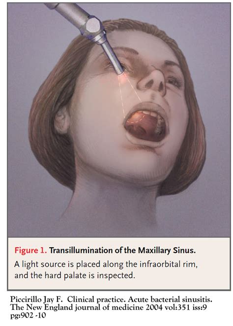 Maxillary Sinus Mucosal Thickening Treatment - Quotes Viral Update