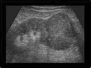 renal cell carcinoma ultrasound - Google Search | Diagnostic medical ...