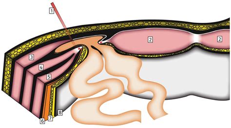 Spigelian Hernia surgical anatomy. Drawing depicting a left-sided ...