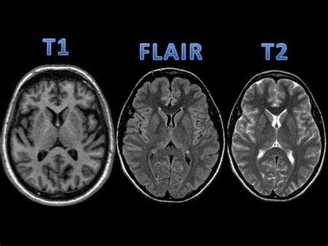 MRI t1 vs t2 - YouTube