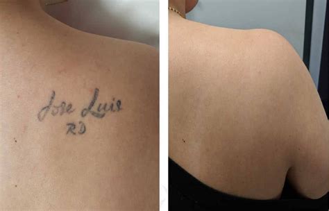 Laser Tattoo Removal: What You Need to Know - Hospital Nino Jesus