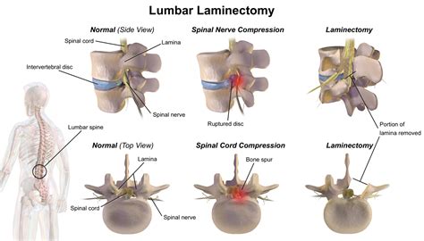 Lumbar Laminectomy and Rhizolysis