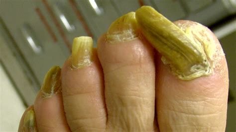 What Causes Thick Toe Nails - Nail Ftempo