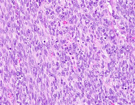 Pathology Outlines - Leiomyosarcoma