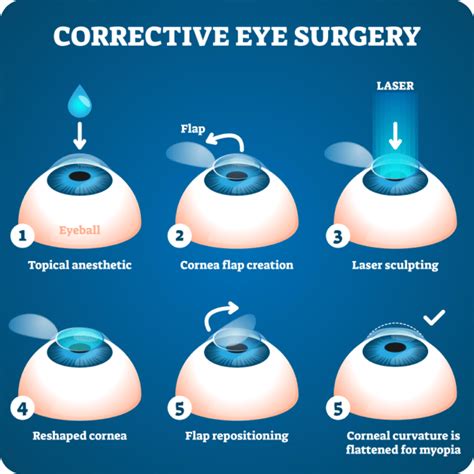 Laser Eye Surgery