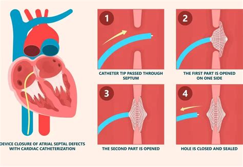 ASD DEVICE CLOSURE: Do You Really Need It? - Dr. Malleswara Rao