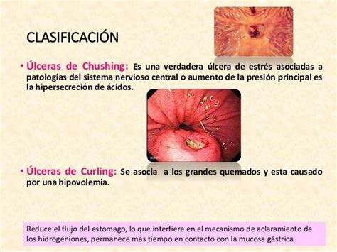 ULCERA DE CURLING PDF