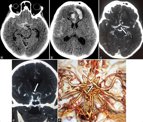 Brain Aneurysm Ct Scan