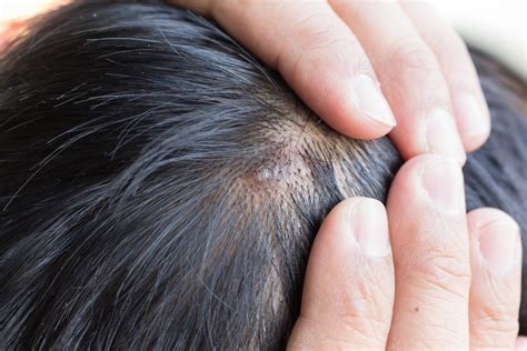 Scalp Psoriasis: Symptoms, Causes, Treatment & Tips - BeatPsoriasis.org