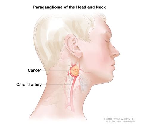 Cancerous Lumps On Neck