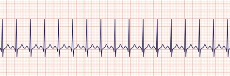 ACLS Rhythm Strips Training and Interpretation