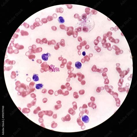 Human blood smear under 100X light microscope with atypical lymphocytes ...