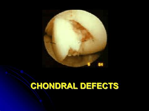 N° 2- Etiopathology of chondral defects