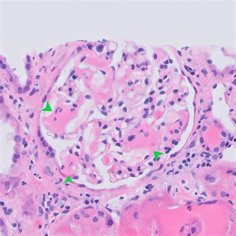 Kidney Biopsy of the Month: Amyloidosis - Renal Fellow Network