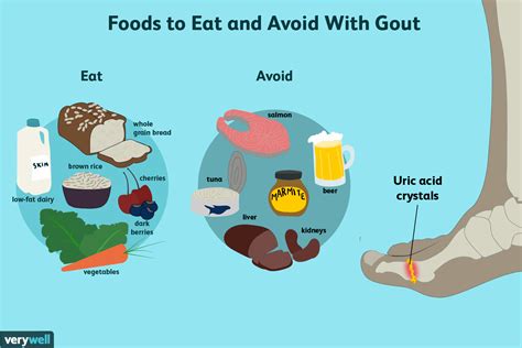 Learn What Foods to Eat to Reduce Gout Symptoms (2022)