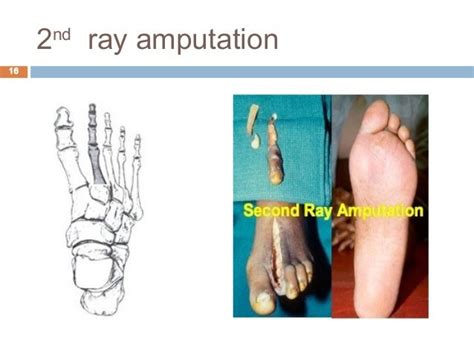 Prosthetic management of symes and partial foot amputation