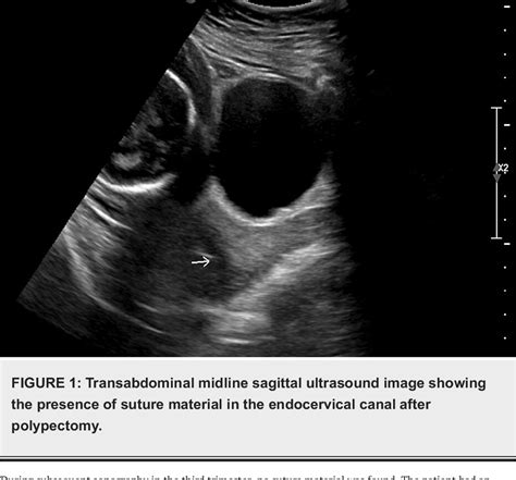 Figure 1 from Role of Ultrasound in Managing Cervical Polyps During ...