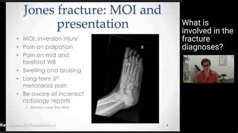 5th Metatarsal Fractures - Treatment & Diagnosis - YouTube