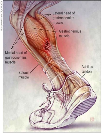 Chronic Achilles Tendon Pain: Diagnosis & Treatment | HSS