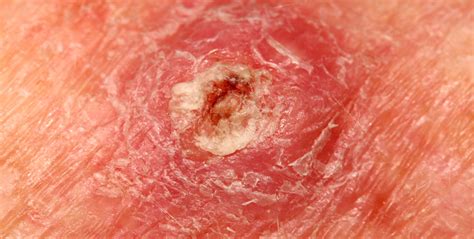 Squamous Cell Skin Cancer Photos