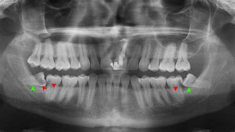 How To Take Care Of Wisdom Teeth - Treatbeyond2