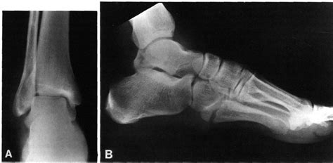 Talus Fracture