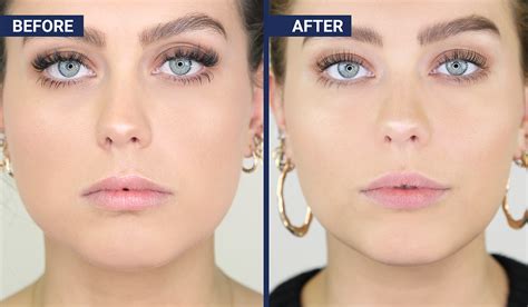 Before and after: Botox jaw injections to slim your face - beautyheaven