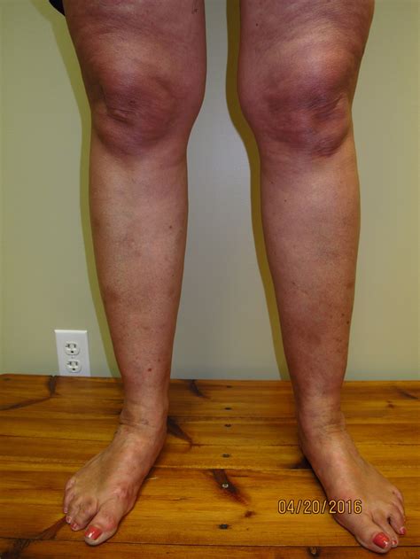 Lipedema — Symmetry Vascular Center