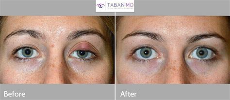 Eyelid Chalazion Surgery Before and After Gallery | Taban MD