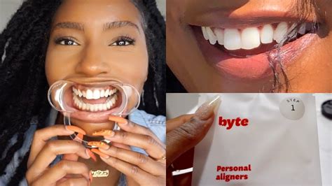 Fixing my TEETH!! Affordable Aligners to Straighten Teeth| My Byte ...