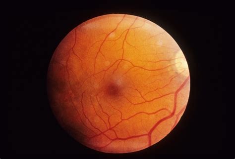 Neovascularization - Retina Image Bank