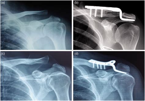 Fifteen-degree clavicular hook plate achieves better clinical outcomes ...