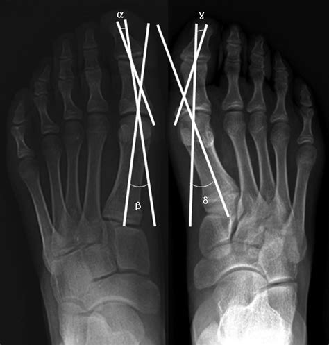 Great Toe Proximal Phalanx Fracture