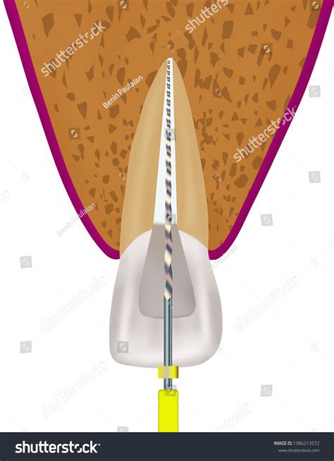 근근관처리를 중심부근에서 내도파일을 이용한 것 스톡 일러스트 1986213572 | Shutterstock