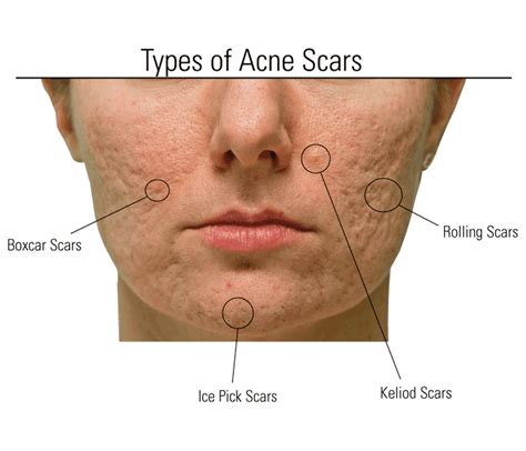 From Ice pick scars to Hyperpigmentation: Treat Acne Scars Naturally ...