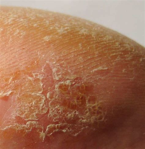 Scaling skin: Pictures, causes, treatment, and prevention