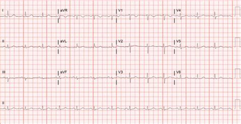 ECG demonstrating sinus rhythm. | Download Scientific Diagram