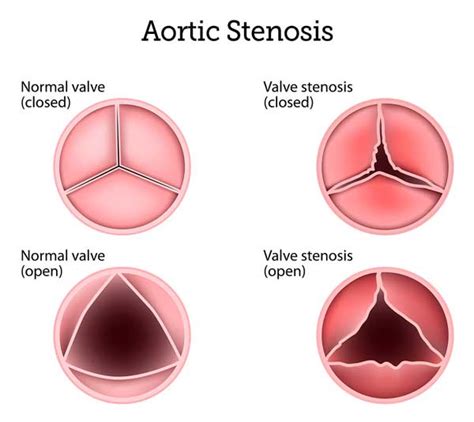 Aortic Stenosis - Symptoms, Causes &, Surgery